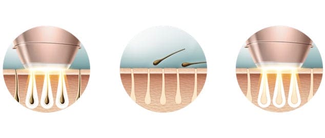 TecnoDepil IPL: Depilación Láser Profesional en Casa