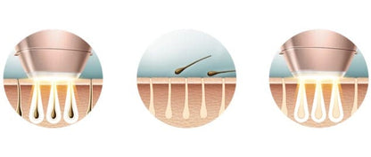 TecnoDepil IPL: Depilación Láser Profesional en Casa